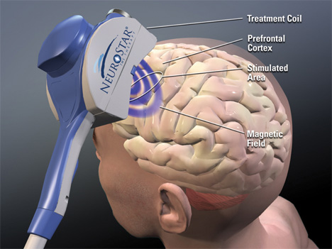 neurostar magnetic waves depression treatment