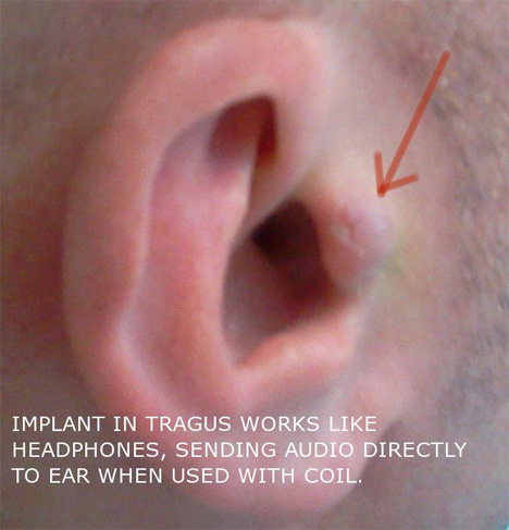 diy headphone implant