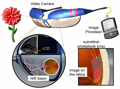 retinal implant