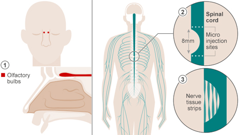 olfactory bulb cells transplant